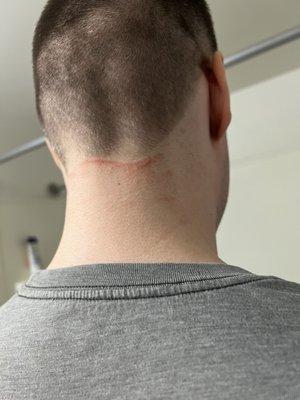 Pain all over the whole back of the neck from electric clippers.