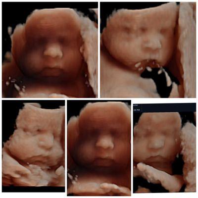 Ultrasound 3D/4D/HD live