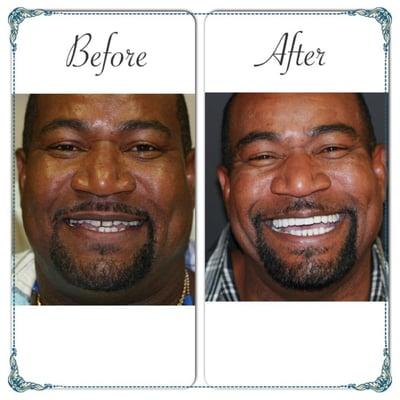 Here is a before and after of one of Dr. Kuhl's smile makeovers.