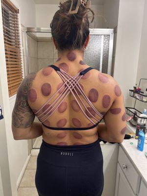 Cupping