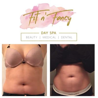 Loose 2"+ inches in as little as 20 minutes from the FDA-approved Strawberry laser Lipo treatment.