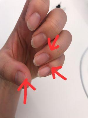 Bleeding after removing gel and filing nails