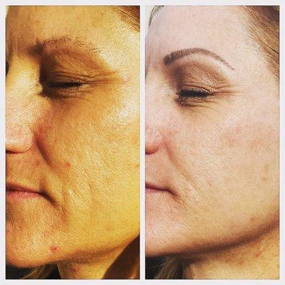 This before and after is from 3 microneedling treatments. Shows the firming and lift in her skin.