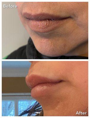 Lip plump to restore volume, erase "smokers lines" and bring back youthful color. (Before and   six weeks after)