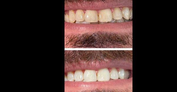 1 hr teeth whitening session- after 3rd session