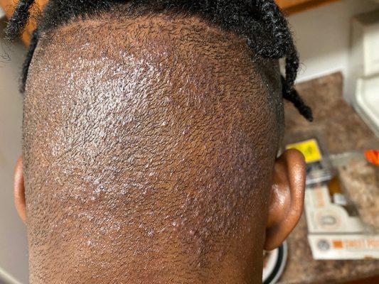 The back of my head from going to the barbershop. Should I sue?