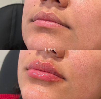 Lip Filler by RN Monique