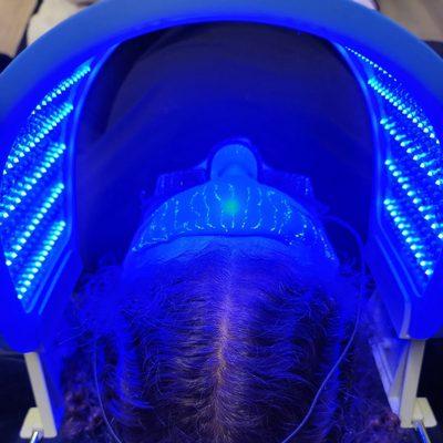 Acne Blue light therapy