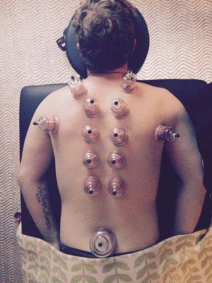 Cupping therapy