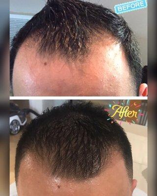 Before and after 3 PRP hair restoration treatments!