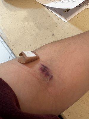 Bruise from blood work