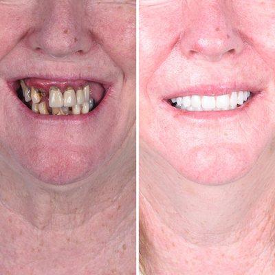 Final result of full mouth dental implants!