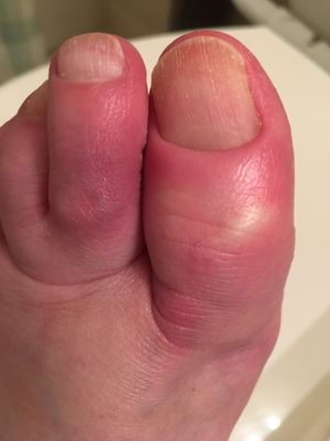 Infected toes