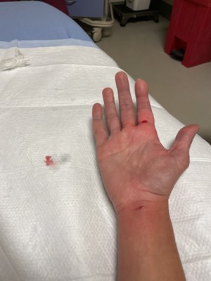 The second finger swelling expands to reach all the finger. The surgeon had to numb the full hand