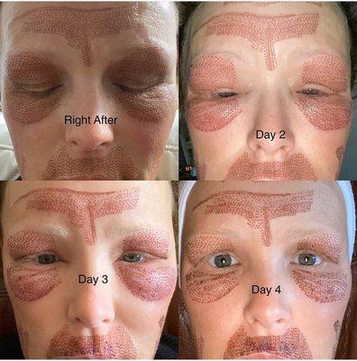 Are you ready to see how magically Fibroblast Plasma improved her skin? The healing process begins.