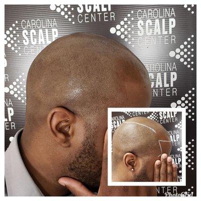 Carolina Scalp Center can give you a clean cut look that will last for years!