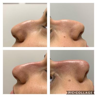 Non surgical nose augmentation by Elle