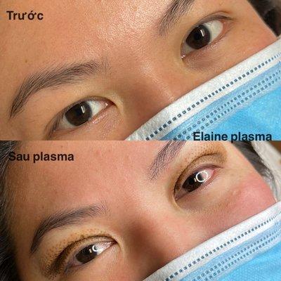 Lifted upper eyelid bleph by plasma pen fibroblast