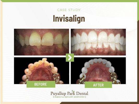 Puyallup Park Dental Family Emergency Implants Braces Invisalign | 13909 Meridian E suite a-1, Puyallup, WA 98373 | Call: (253) 435-0333