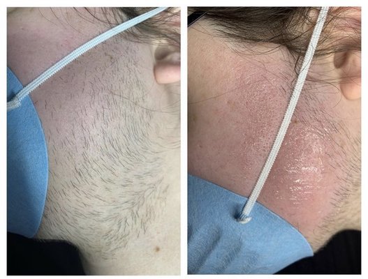 Before and immediately after facial hair treatment (takes a series of treatments to achieve permanent hair removal)