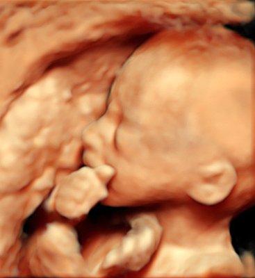 3D HD ultrasound - 20 weeks Baby girl