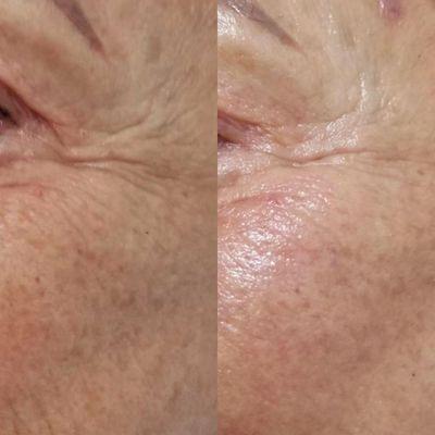 My anti-aging facial after 1 treatment. You can see her skin is rejuvenated and her wrinkles and lines have softened up.