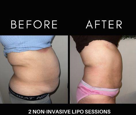 two non invasive laser lipo sessions loose 2 inches off your waist with every session .