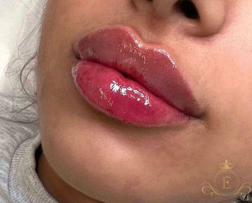 Lip Enhancement with dermal filler