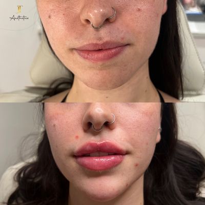 LIP + CHIN FILLER