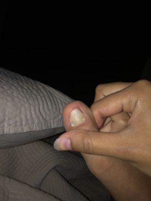 TOENAIL FUNGUS FROM THIS SHIT PLACE