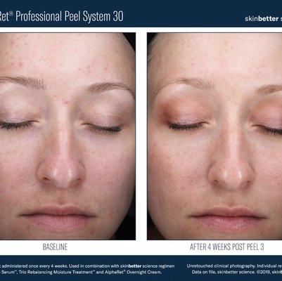 Peel Before/After Chemical Peels