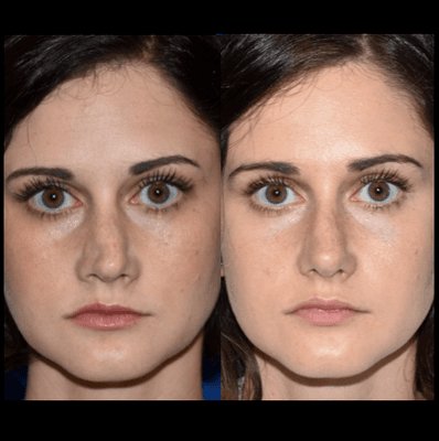 Revision Rhinoplasty