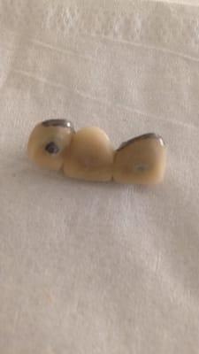 3 tooth bridge suppose to be none metal he said. Got it removed as you can see its metal.