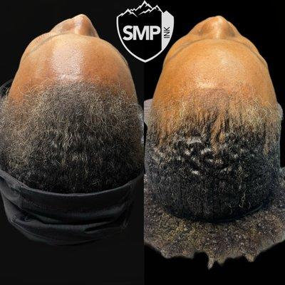 Scalp Micropigmentation Density Fill and Hairline Restoration