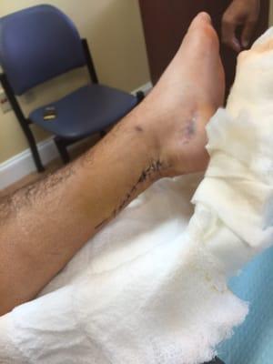 1 week post surgery Achilles full rupture