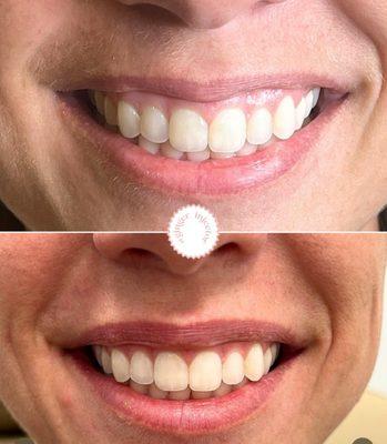 Before and after -- lip flip & gummy smile treatment using Neurotox