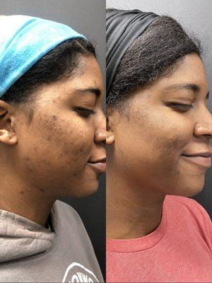 Before and After discoloration & Acne transformation!!