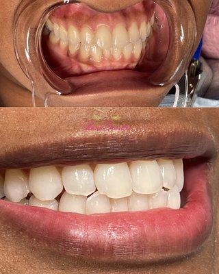 Teeth whitening services. 
We have two (2) options 
Basic 1 hr 
Advanced 1hr & 30 mins