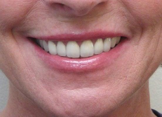 After--Confidence with a big new smile.