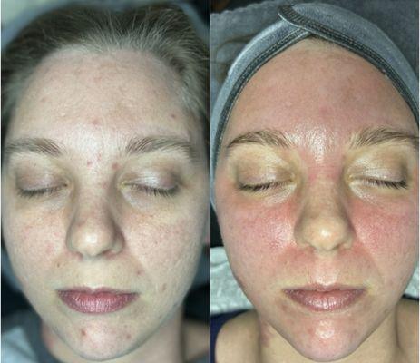 Chemical Peel