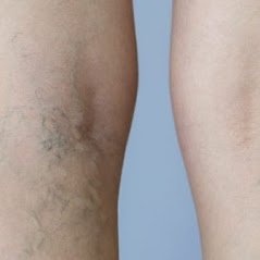 With age, many individuals notice jagged purple lines or swollen bluish cords spreading across their thighs and calves. Call (312) 414-1088