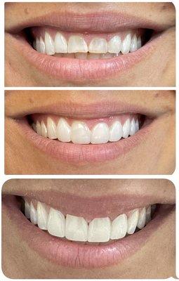 Veneers (before , temporaries, final )