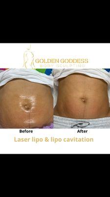 One session laser lipo and lipo cavitation