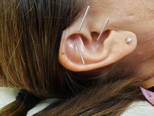 Ear acupuncture is used to help balance the nervous system for sleep, anxiety, PTSD.