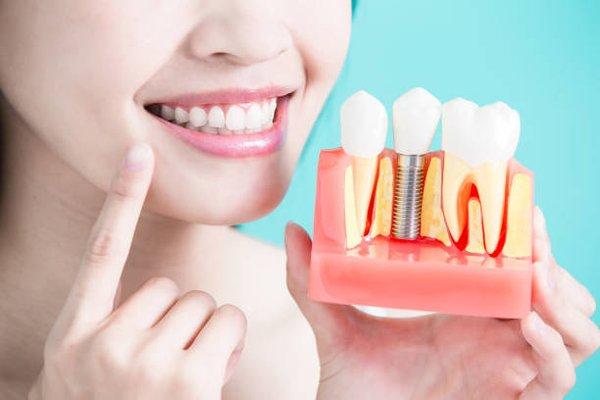 Dental Implant By Dr. Sumit Sehgal