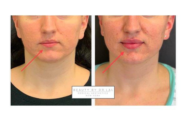 Dr. Lal treated this patient with 1 Syringe of Restylane Silk to the upper and lower lip for a full rejuvenation + balance.