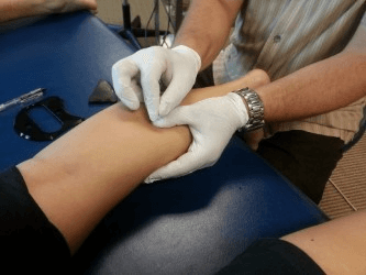 Dry Needling