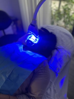 Teeth Whitening