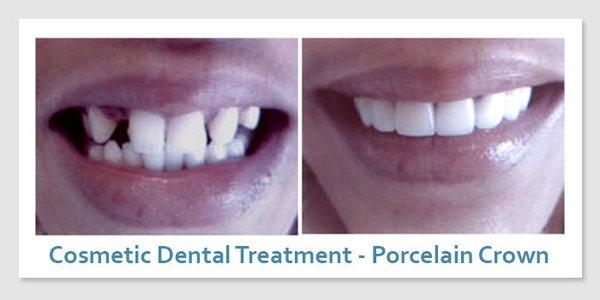 Before and After Porcelain Crowns