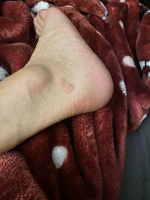 Bed bug bites